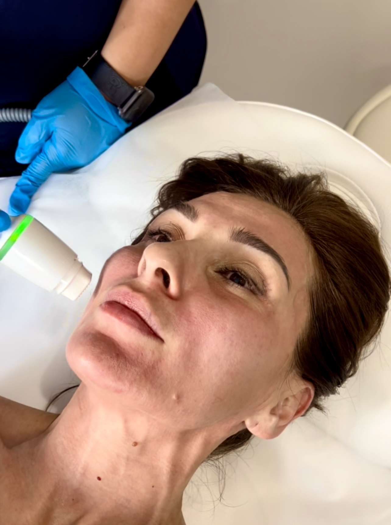 Skin Loft RF Microneedling treatment being performed to tighten skin and reduce fine lines