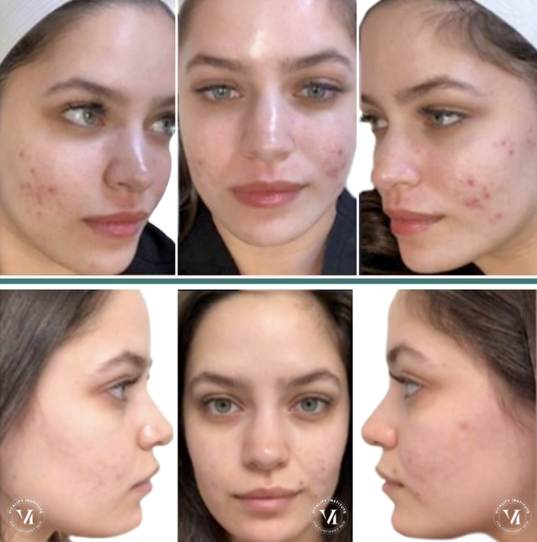 young woman with acne in a series of before and after images showing visibly clearer and smoother skin following VI peel treatment