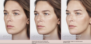 Before and after images showing facial rejuvenation after Juvederm filler injections with smoother skin and enhanced volume