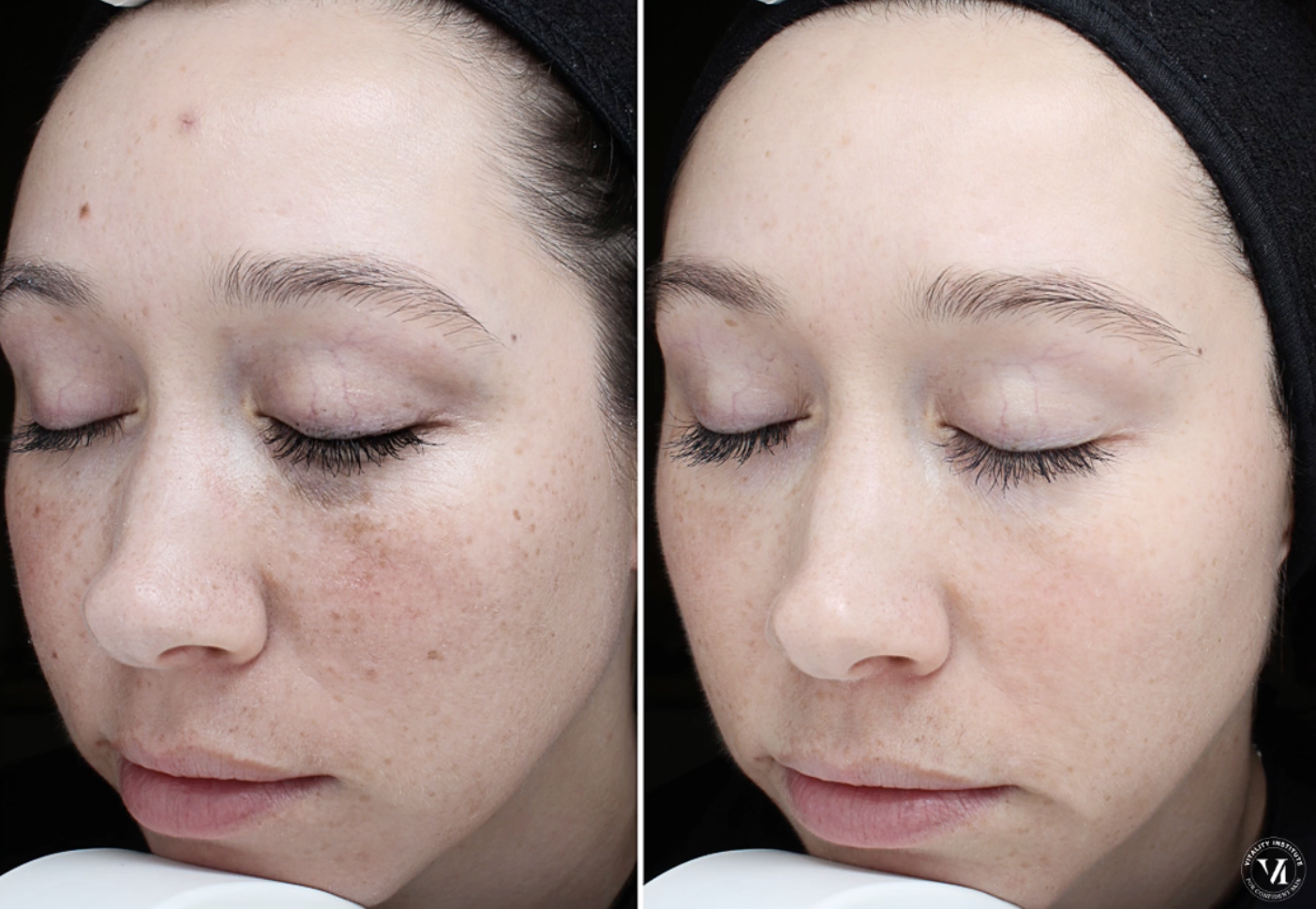 woman with eyes closed showing before and after results of VI peel original treatment