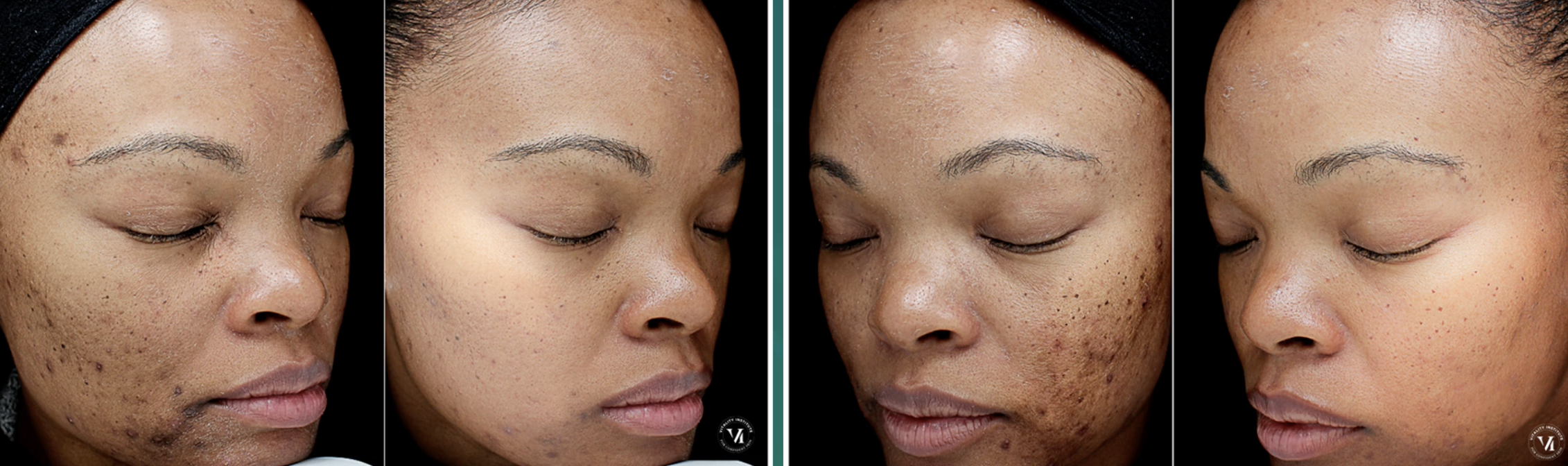 side-by-side before and after photos of a woman with dark spots and acne showing clearer smoother skin following VI peel original treatment