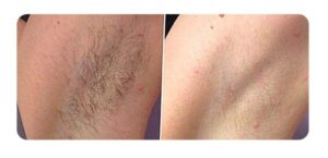 Armpit Hair Removal