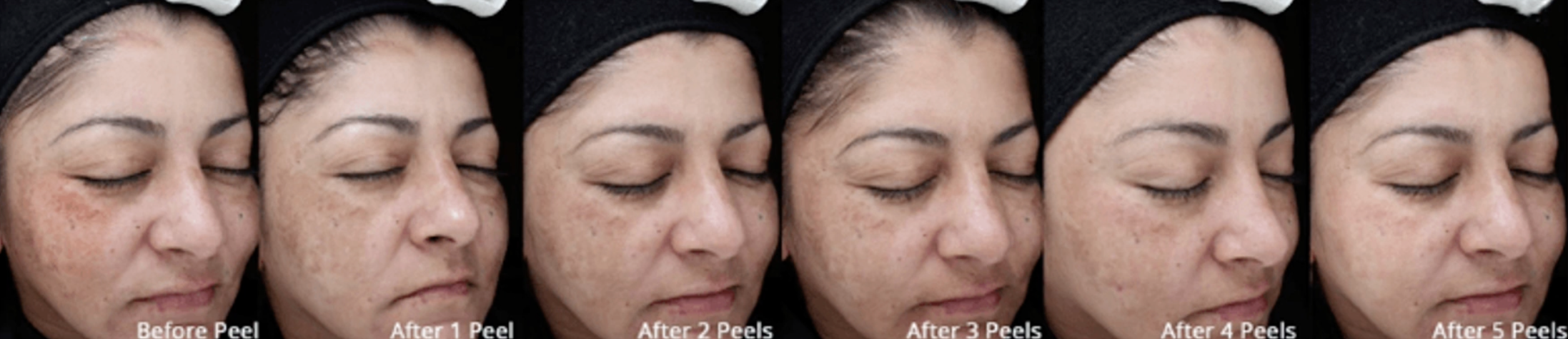 Skin Loft client's progress photos before and after 1 to 5 VI Peel Precision Plus treatments showing gradual reduction of hyperpigmentation.