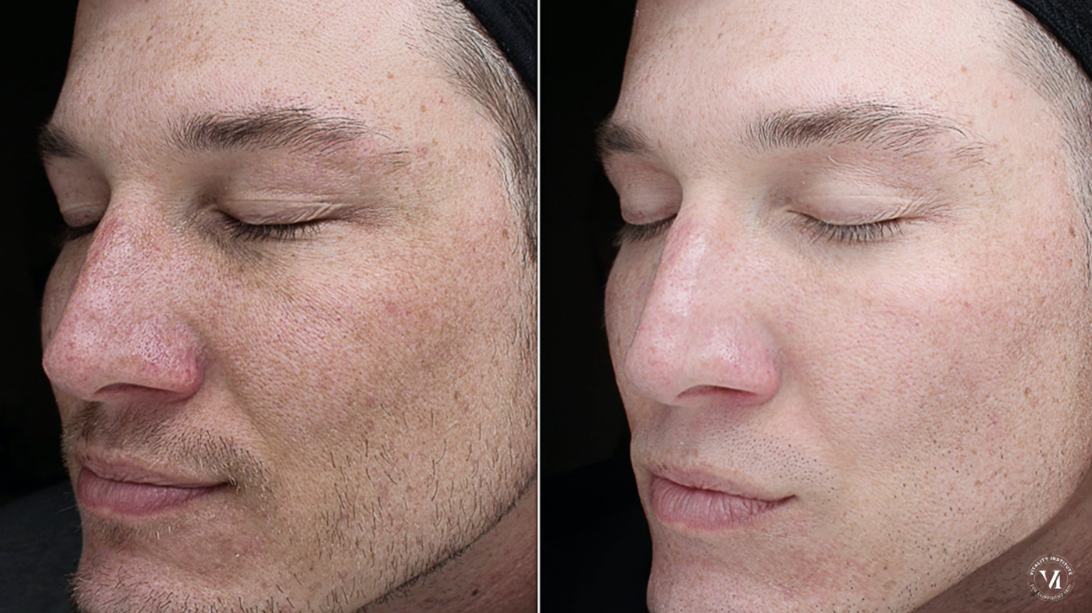 Before and after VI Peel treatment on a man showing smoother skin reduced redness and improved texture