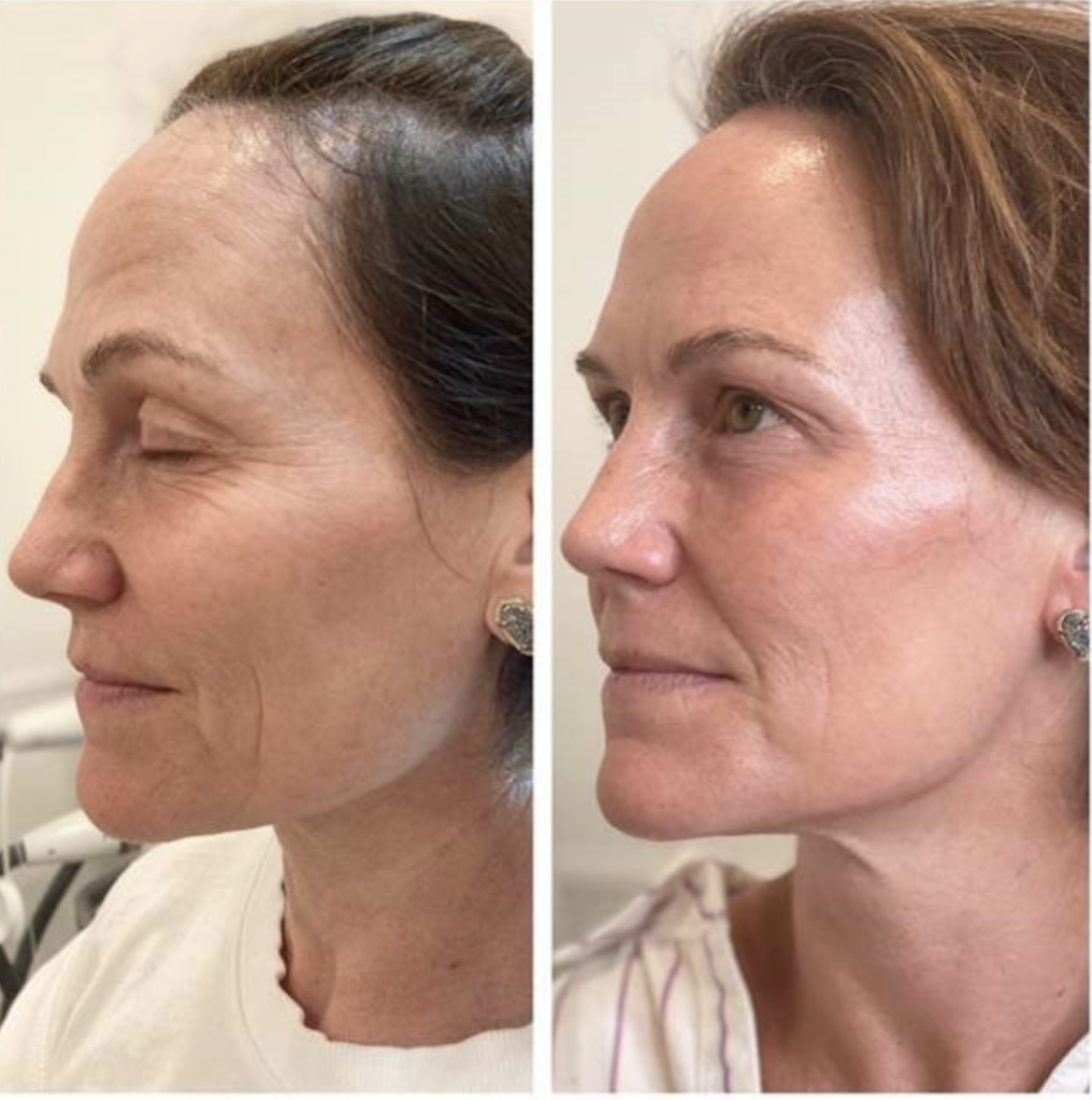 Before/After SL SmoothGlo