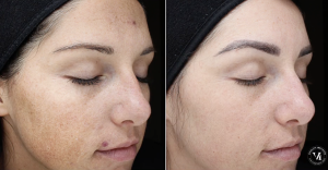 Before and after VI Peel treatment showing reduced acne, pigmentation, and improved skin texture