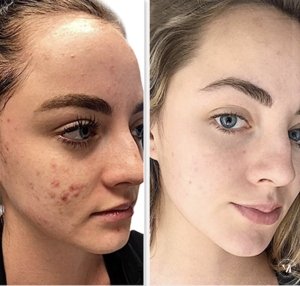 Before and after acne treatment showing clearer skin and reduced blemishes after professional care and VI Peel