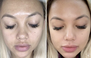 Before and after VI Peel treatment showing improved skin tone reduced hyperpigmentation and smoother complexion