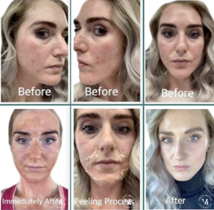 Before and after VI Peel progression showing acne-prone skin post-treatment peeling phase and clearer smoother skin after recovery