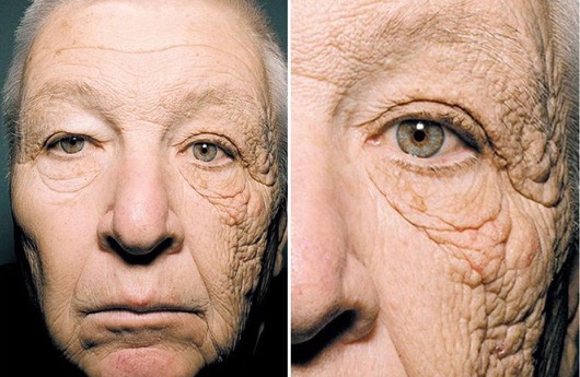 elderly man with significant sun damage and deep wrinkles on one side of his face due to prolonged UV exposure over time