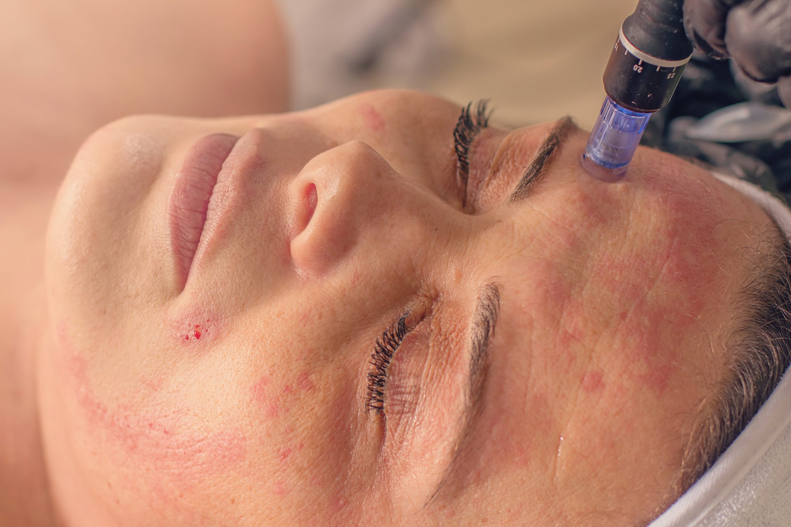 Close up of Needle Mesotheraphy on a Woman's Face