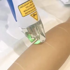 Close-up of laser hair removal device during treatment on forearm skin