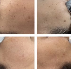 Close-up progression of laser sunspot removal treatment showing gradual fading of dark spots on the forehead