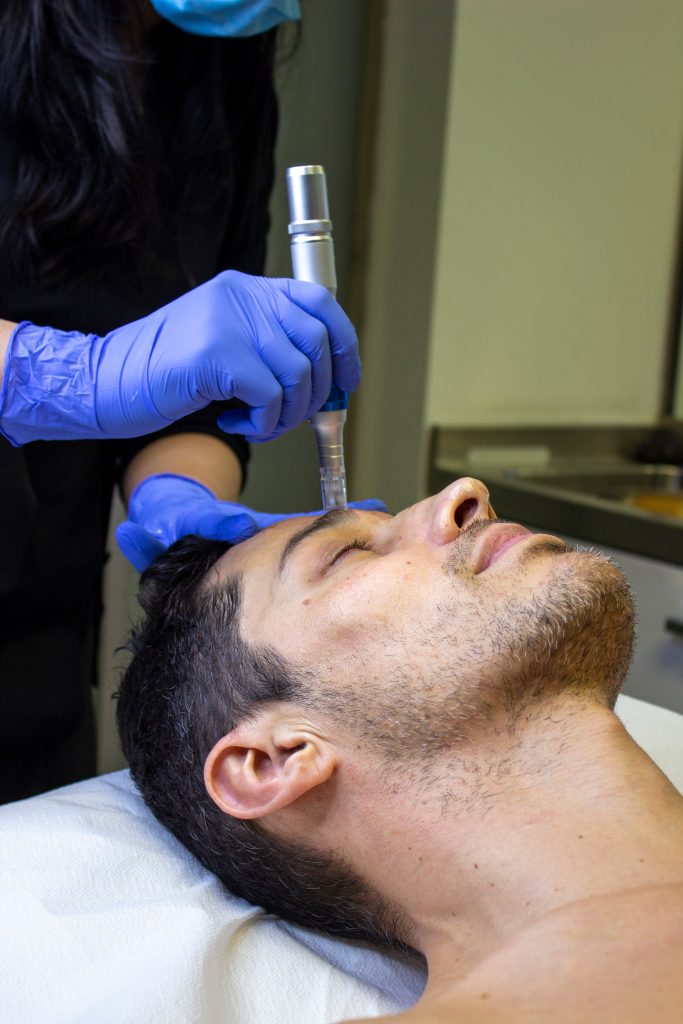 man having microneedling in a skin clinic