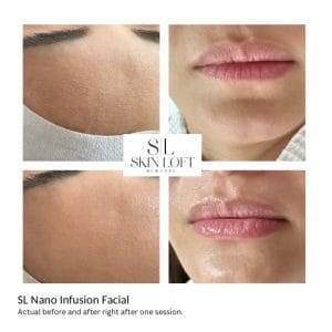 Before and after results of SL Nano Infusion Facial showing smoother skin and fuller lips after one session at Skin Loft New York