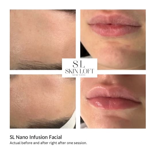 SL Nano Infusion Facial