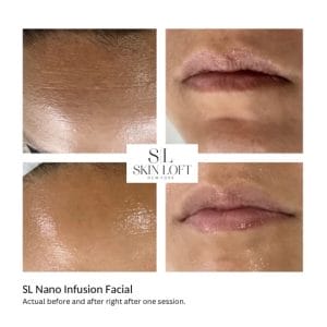 SL Nano Infusion Facial