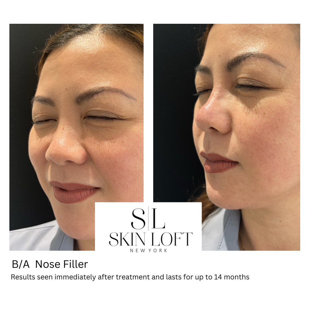 nose filler